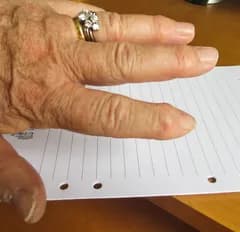 Varför kan inte reumatiska fingrar opereras?