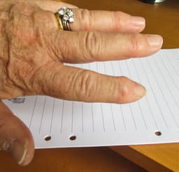 Varför kan inte reumatiska fingrar opereras?